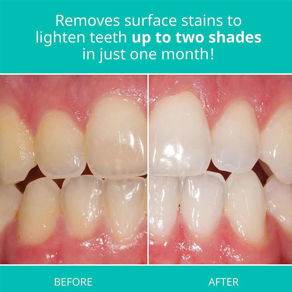 Opalescence Whitening Toothpas - огляд і ціна Teeth Whitening Opalescence