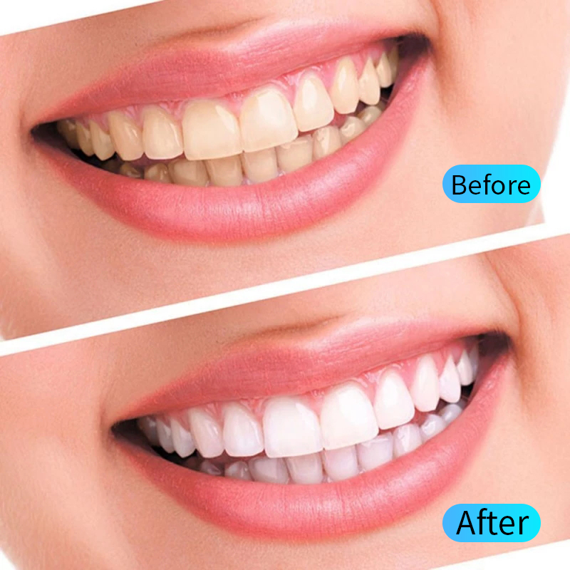 Teeth Whitening Gel Kit Oral H - огляд і ціна Teeth Whitening Opalescence