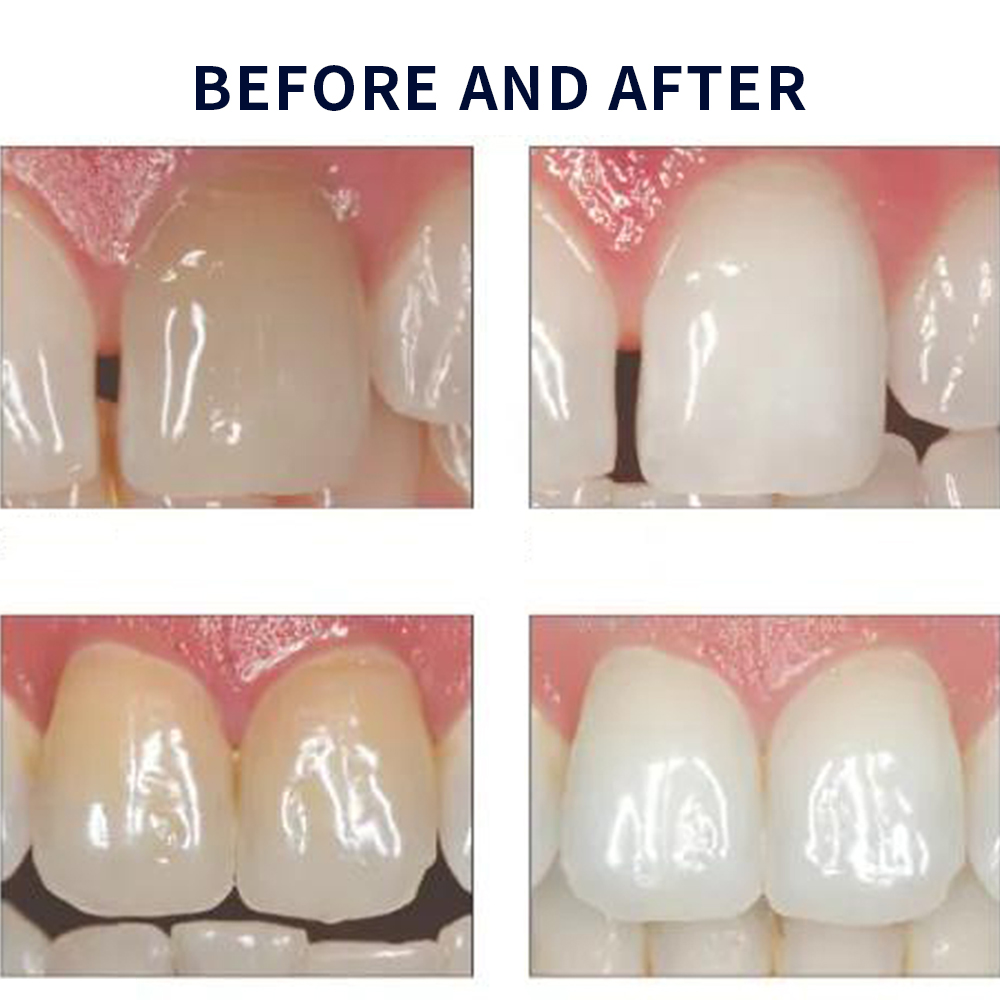 Opalescence Whitening 20% PF 2 - огляд і ціна Teeth Whitening Home Kit