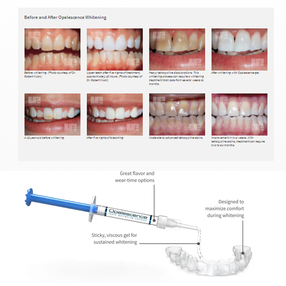 Opalescence Whitening 20% PF 2 - огляд і ціна Teeth Whitening Home Kit