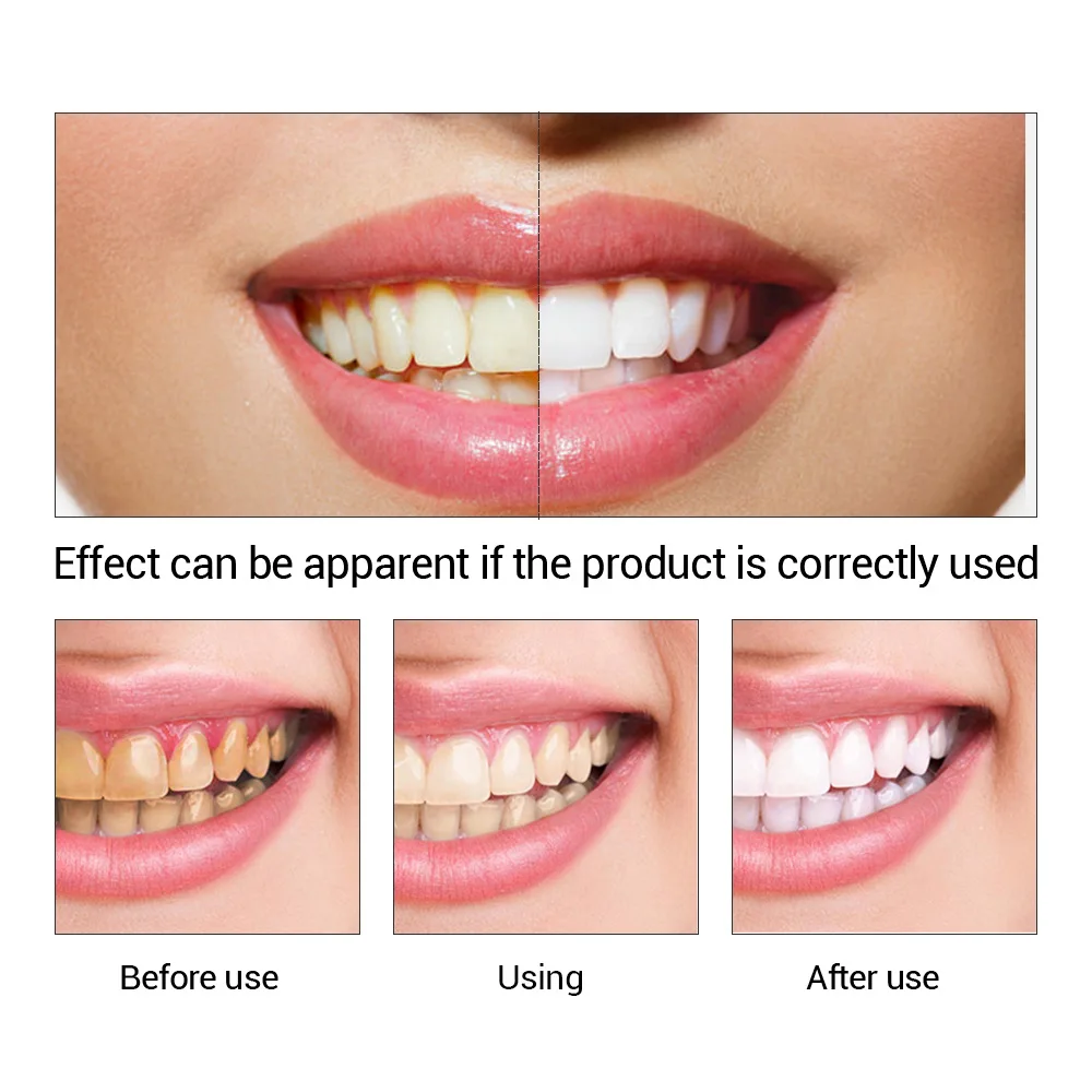 FTEENPLY Teeth Whitening Essen - огляд і ціна Teeth Whitening (Bleaching)