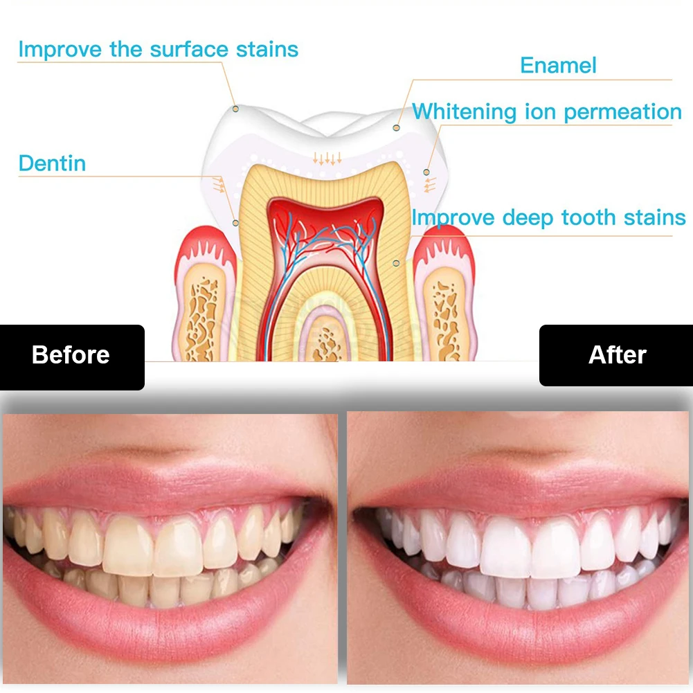 Dental Teeth Whitening Kit Min - огляд і ціна Teeth Whitening Opalescence